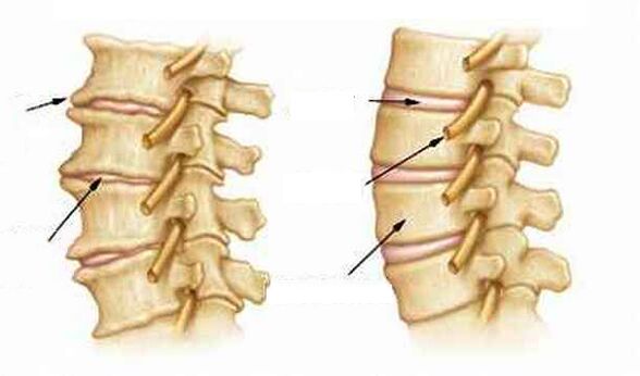 Que é a osteocondrose