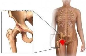 As razóns para o desenvolvemento da artrose da articulación da cadeira