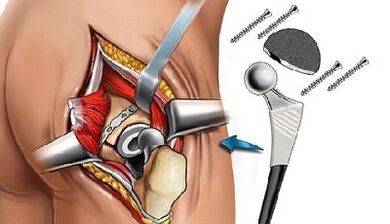 Endoprostéticos para as gargantas da estrela da cadeira
