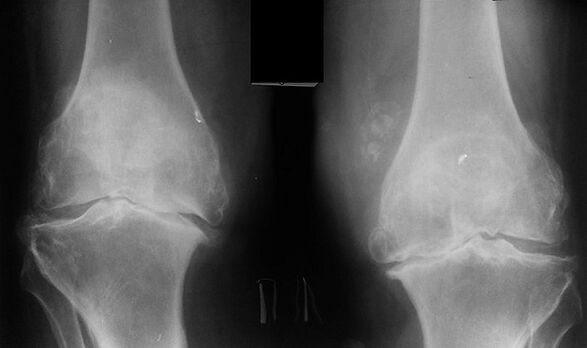 X -ray como medio para diagnosticar a osteoartrite da articulación do xeonllo