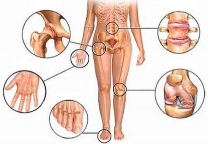 Artrite e artrosis de diferentes articulacións