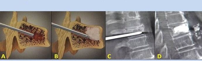 Vertebroplastia de punción para dor de costas
