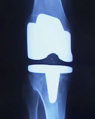 Radiografía dun xeonllo cunha prótese artificial despois da cirurxía de substitución articular