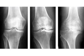 Fases da artrose da articulación nunha radiografía