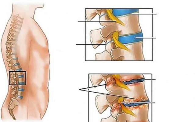 A osteocondrose da columna lumbar causa dor nas costas